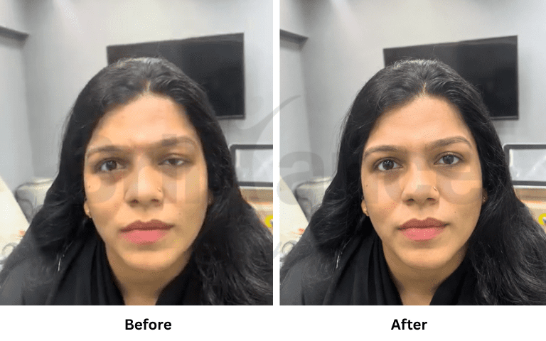profhilo-skin-texture-hydration-improvement-results-mumbai (15)