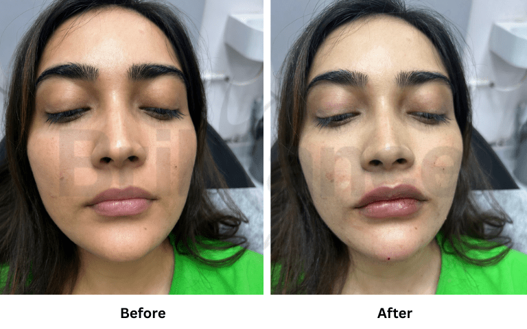 profhilo-skin-texture-hydration-improvement-results-mumbai (23)