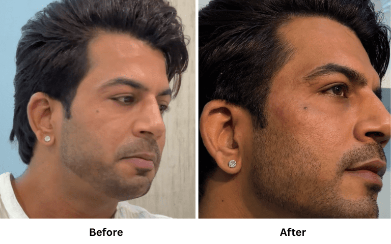 profhilo-skin-texture-hydration-improvement-results-mumbai (26)