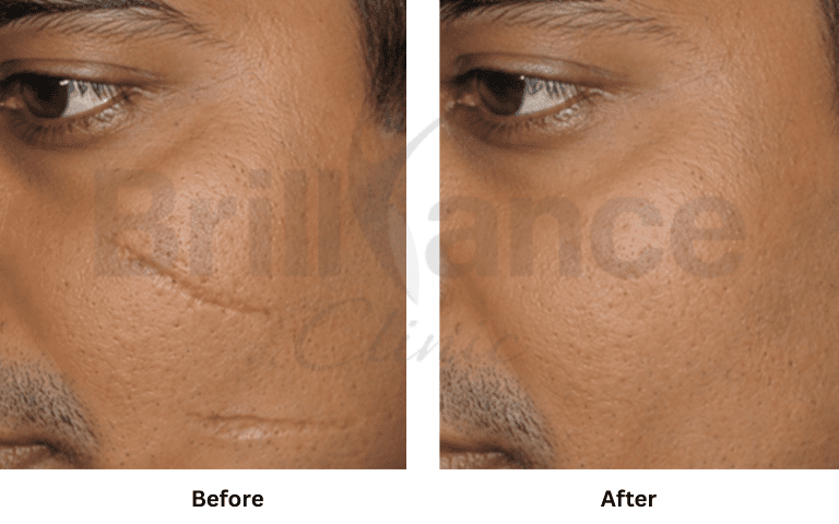 profhilo-skin-texture-hydration-improvement-results-mumbai (28)
