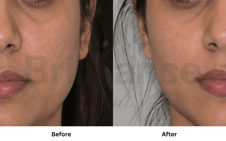 profhilo-skin-texture-hydration-improvement-results-mumbai (29)