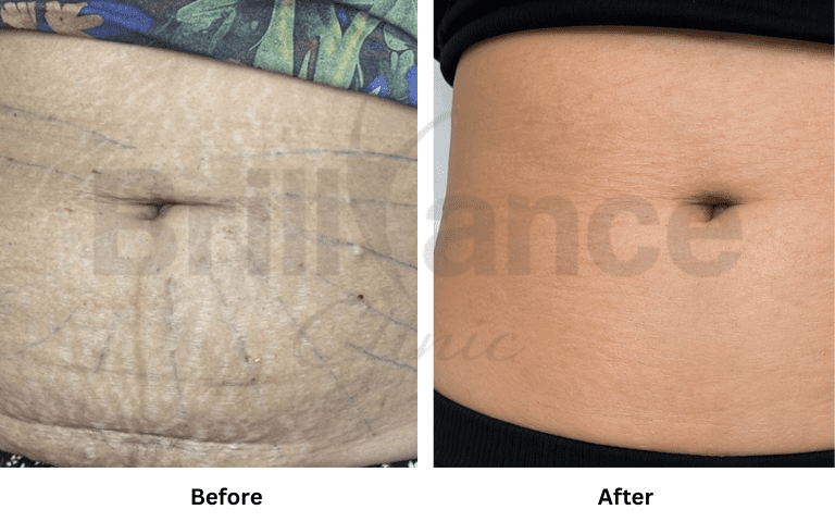 profhilo-skin-texture-hydration-improvement-results-mumbai (35)