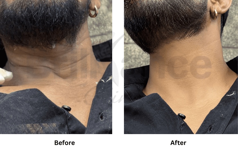 profhilo-skin-texture-hydration-improvement-results-mumbai (36)