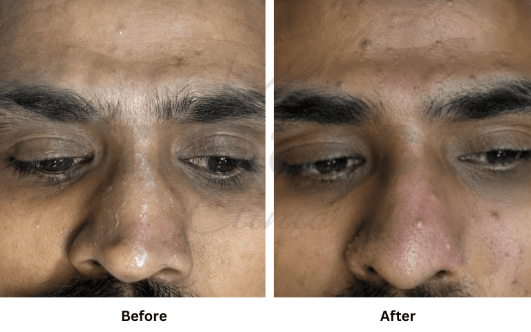 profhilo-skin-texture-hydration-improvement-results-mumbai (37)