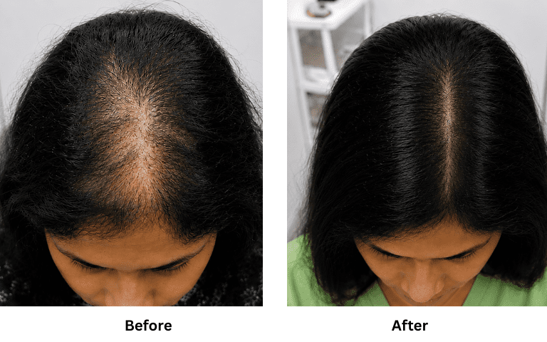 profhilo-skin-texture-hydration-improvement-results-mumbai (38)