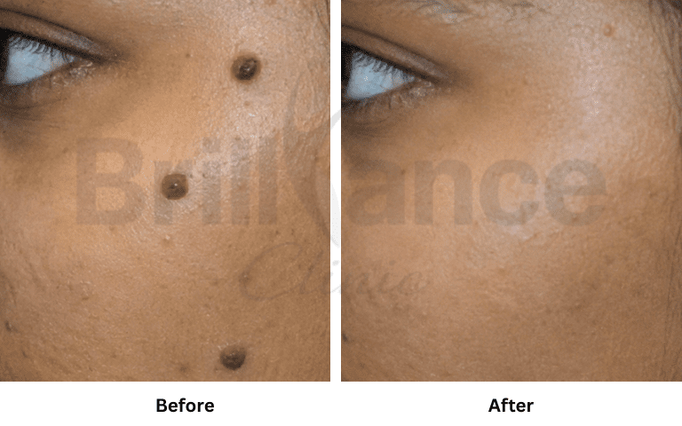 profhilo-skin-texture-hydration-improvement-results-mumbai (40)