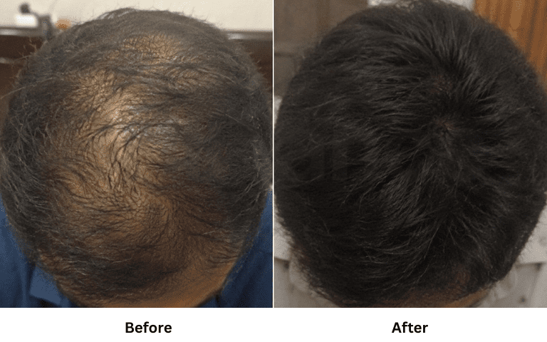profhilo-skin-texture-hydration-improvement-results-mumbai (43)
