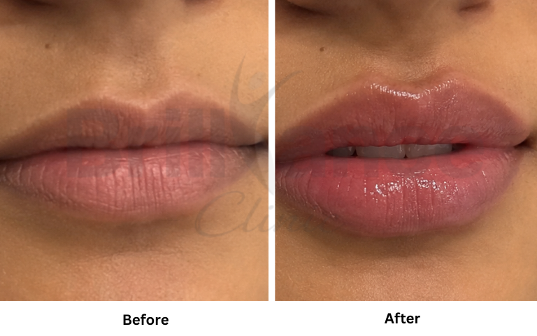 profhilo-skin-texture-hydration-improvement-results-mumbai (45)