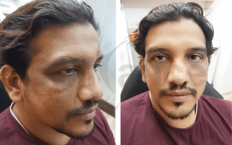 profhilo-skin-texture-hydration-improvement-results-mumbai (5)
