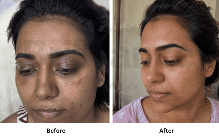 ipl glutathione review Photofacial Skin Rejuvenation Treatment in Mumbai Liquid Liposomal Glutathione –
