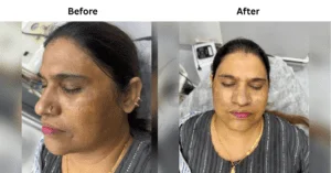 before & after of malasema 2