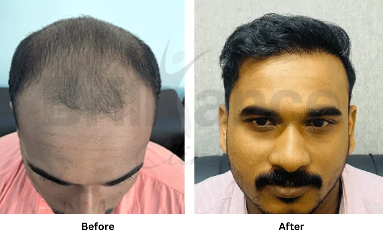 before & after of treatments (33)